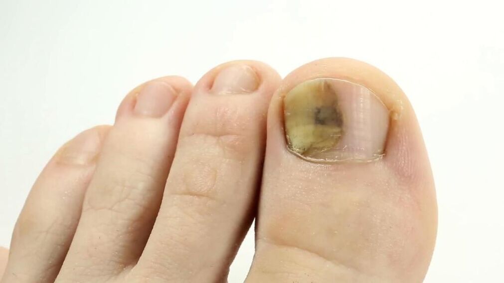The appearance of toenails affected by fungus