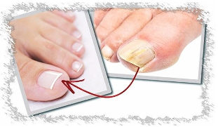The causes of nail fungus