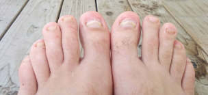 The nail fungus on your feet