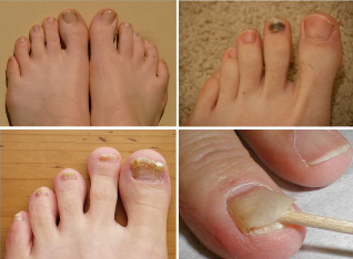 The signs of nail fungus