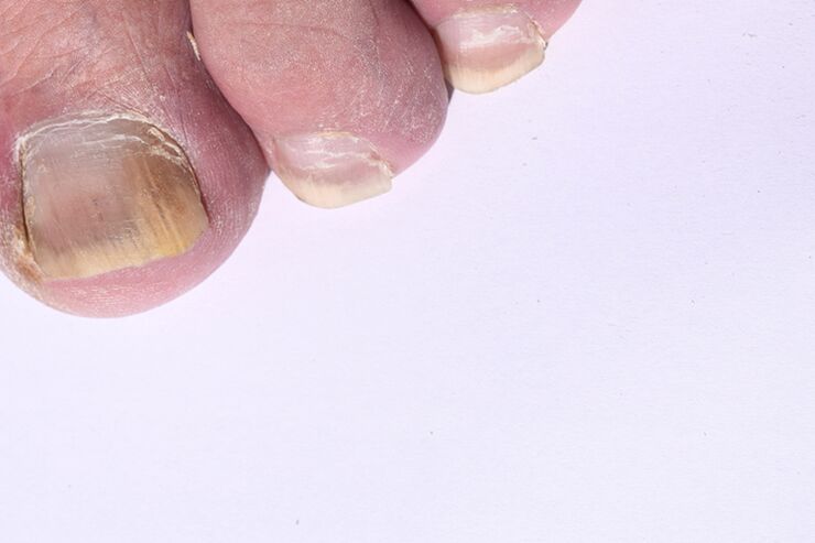 early stages of toenail mycosis