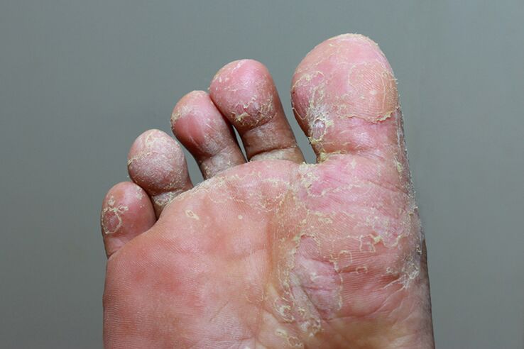severe mycosis of the skin of the toes