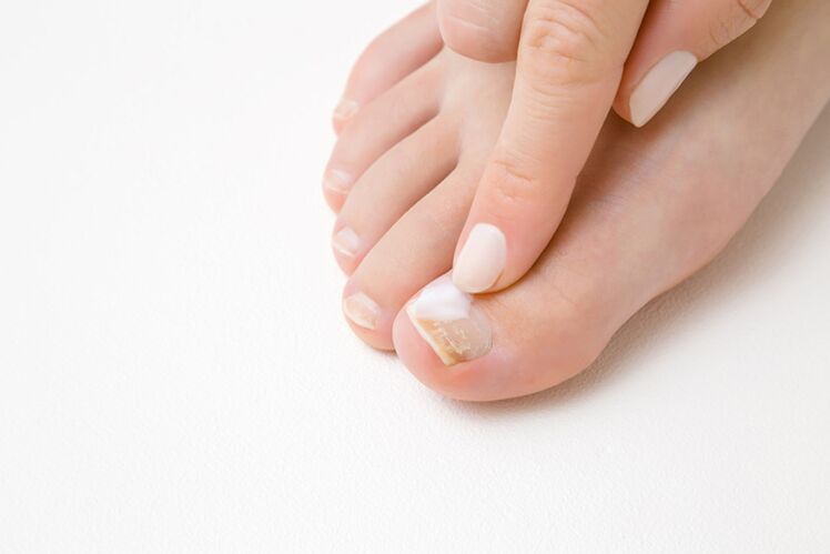 toe treatment with ointment for fungus