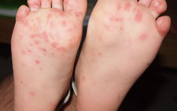 Vesicular fungus forms on the feet