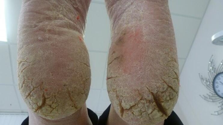 fungal manifestations on the feet