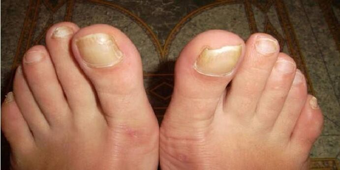 what is toenail fungus like