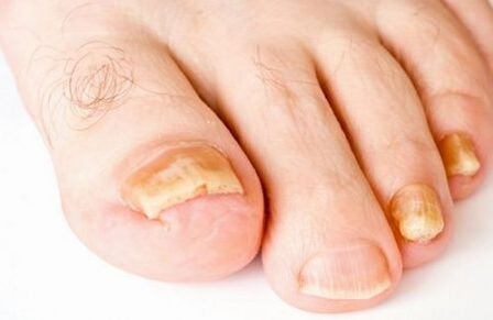 yellowing of toenails with fungus
