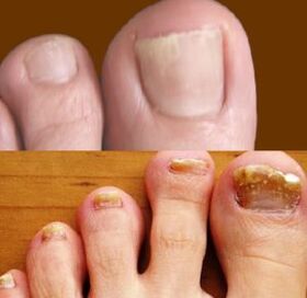 early and advanced stages of fungus on the feet