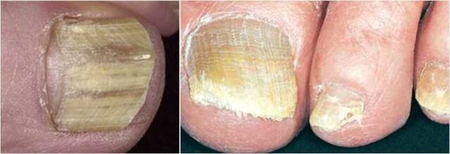 Advanced forms of toenail fungus