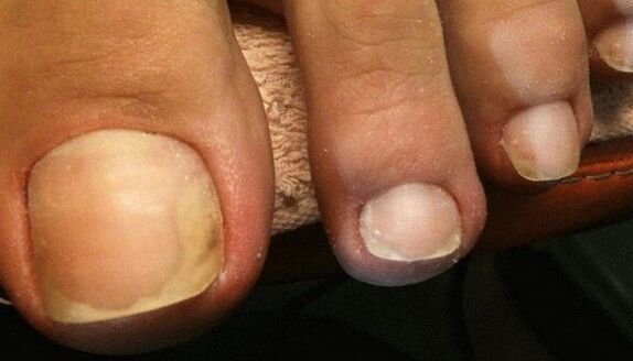 Early stage signs of toenail fungus