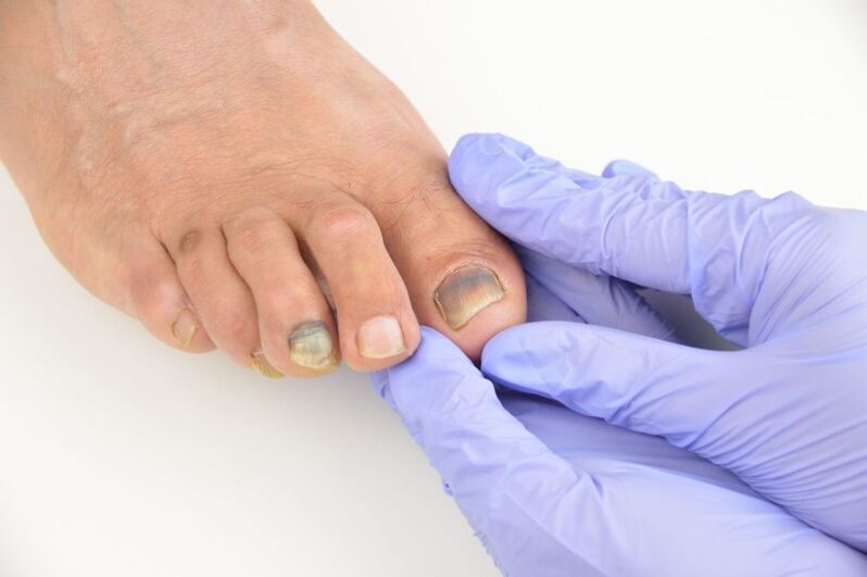 Medical examination of fungal toenails
