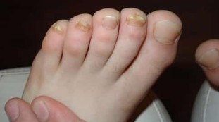 For a fungus to be surprised with almost all of the toes of the foot