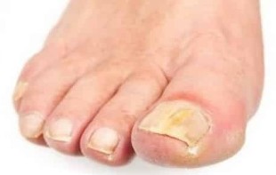 In the initial phase of the fungus in the toenail