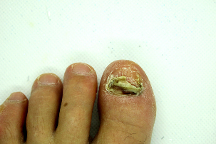 The fungus is under the nails of fingers and toes – hard stage