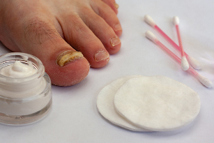 the fungus on the toes of the feet